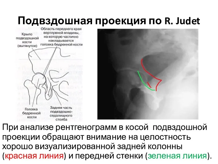 Подвздошная проекция по R. Judet При анализе рентгенограмм в косой