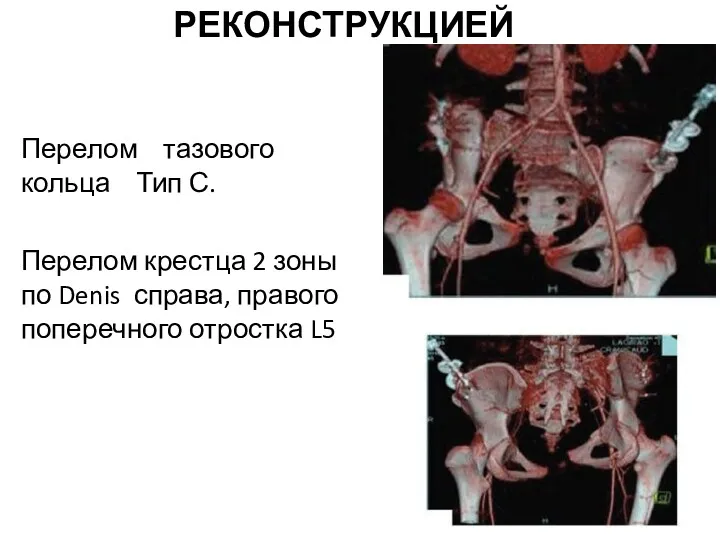 КТ АНГИОГРАФИЯ С 3D-РЕКОНСТРУКЦИЕЙ Перелом тазового кольца Тип С. Перелом