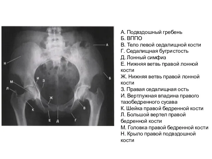 А. Подвздошный гребень Б. ВППО В. Тело левой седалищной кости