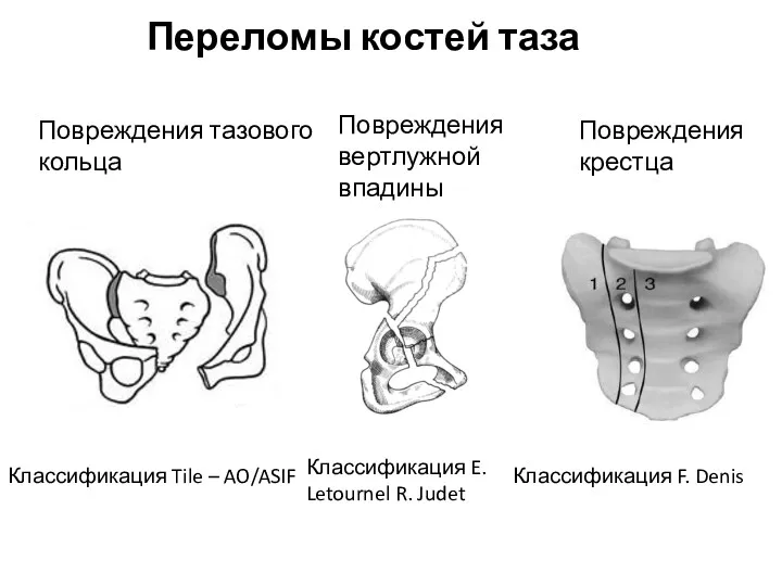 Переломы костей таза Повреждения тазового кольца Повреждения вертлужной впадины Повреждения