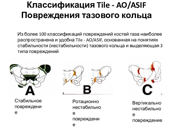 Классификация Tile - AO/ASIF Повреждения тазового кольца Из более 100