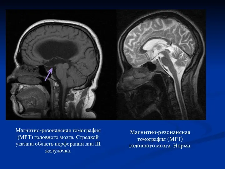 Магнитно-резонансная томография (МРТ) головного мозга. Норма. Магнитно-резонансная томография (МРТ) головного