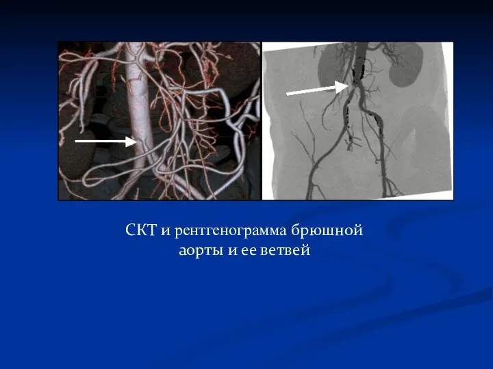 СКТ и рентгенограмма брюшной аорты и ее ветвей