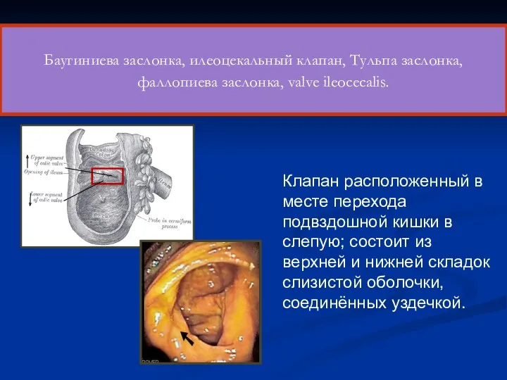 Баугиниева заслонка, илеоцекальный клапан, Тульпа заслонка, фаллопиева заслонка, valve ileocecalis.