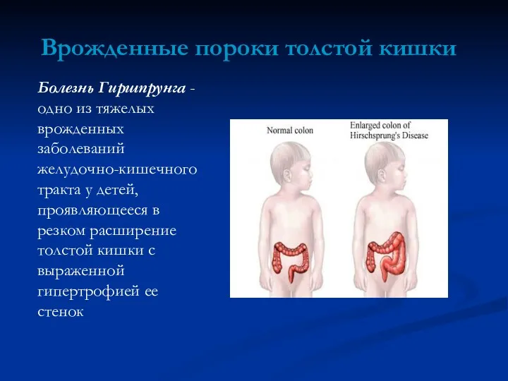 Врожденные пороки толстой кишки Болезнь Гиршпрунга - одно из тяжелых