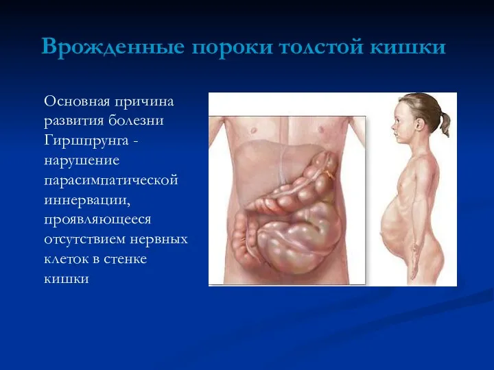 Врожденные пороки толстой кишки Основная причина развития болезни Гиршпрунга -