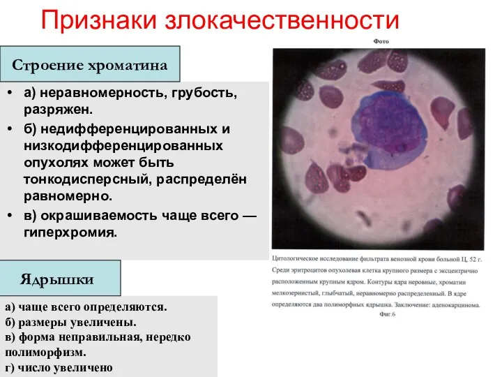 Признаки злокачественности а) неравномерность, грубость, разряжен. б) недифференцированных и низкодифференцированных