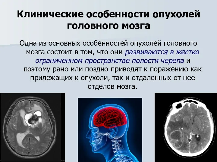 Клинические особенности опухолей головного мозга Одна из основных особенностей опухолей