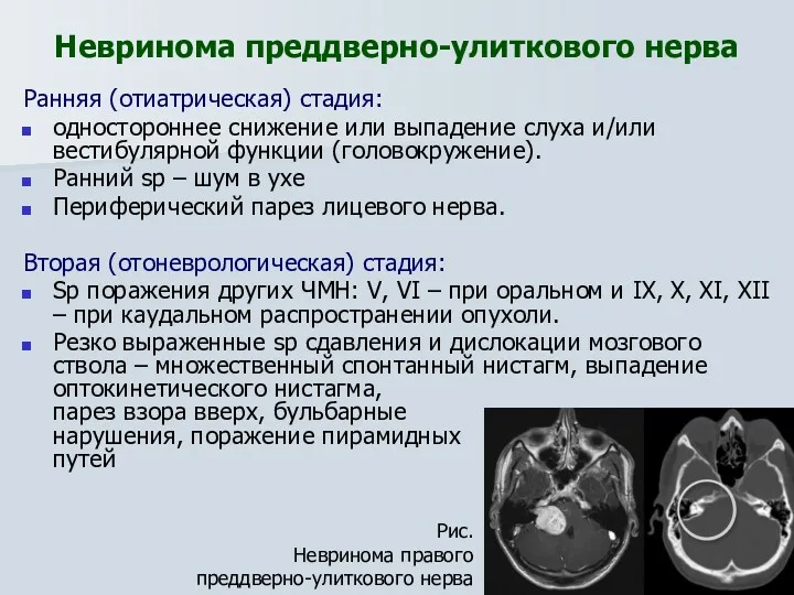 Невринома преддверно-улиткового нерва Ранняя (отиатрическая) стадия: одностороннее снижение или выпадение