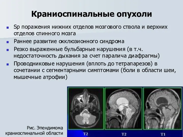 Краниоспинальные опухоли Sp поражения нижних отделов мозгового ствола и верхних