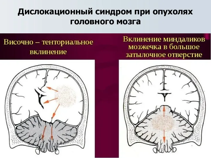 Дислокационный синдром при опухолях головного мозга