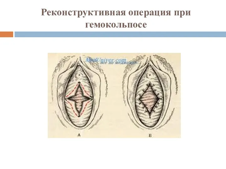 Реконструктивная операция при гемокольпосе