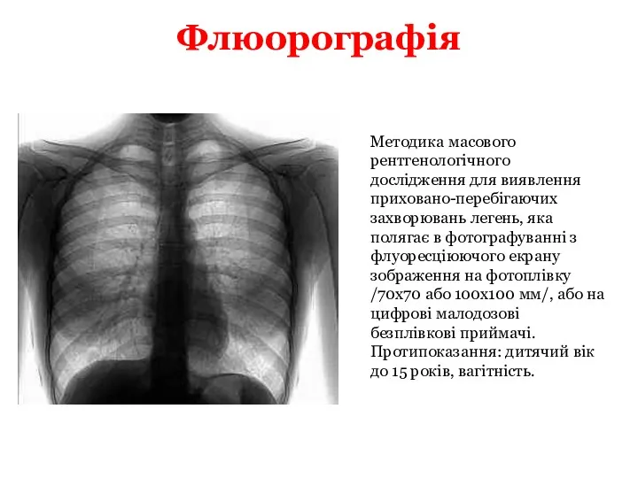 Флюорографія Методика масового рентгенологічного дослідження для виявлення приховано-перебігаючих захворювань легень,