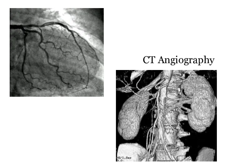 CT Angiography