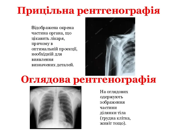 Прицільна рентгенографія Відображена окрема частина органа, що цікавить лікаря, причому