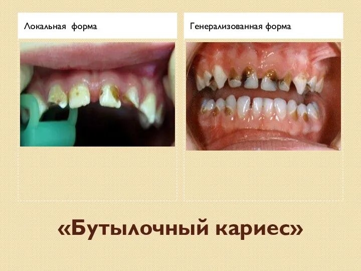 «Бутылочный кариес» Локальная форма Генерализованная форма