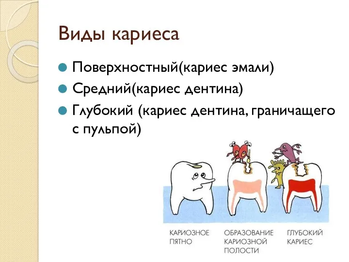 Виды кариеса Поверхностный(кариес эмали) Средний(кариес дентина) Глубокий (кариес дентина, граничащего с пульпой)