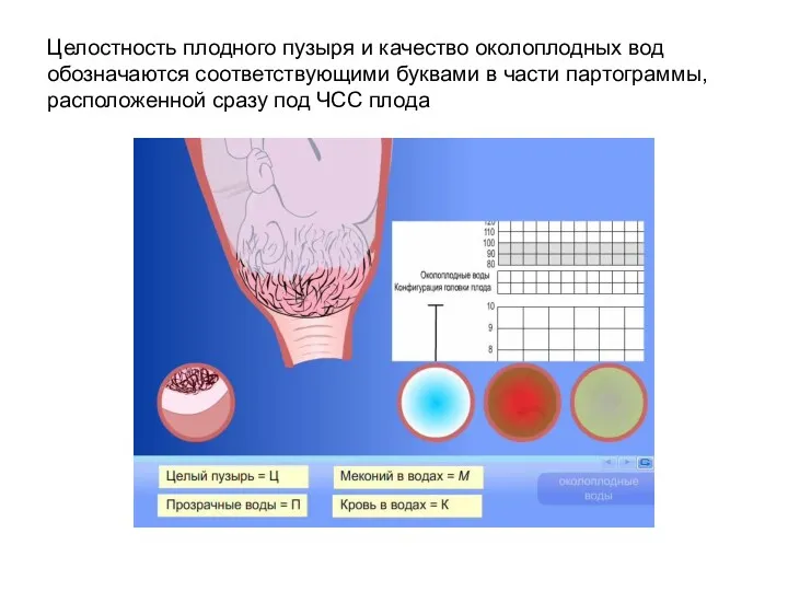 Целостность плодного пузыря и качество околоплодных вод обозначаются соответствующими буквами в части партограммы,