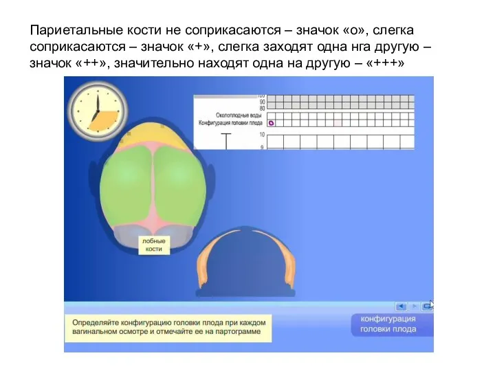 Париетальные кости не соприкасаются – значок «о», слегка соприкасаются – значок «+», слегка