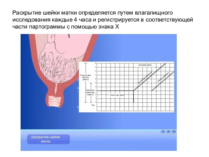 Раскрытие шейки матки определяется путем влагалищного исследования каждые 4 часа и регистрируется в