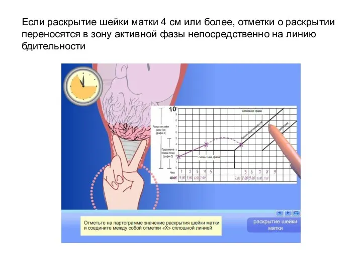 Если раскрытие шейки матки 4 см или более, отметки о раскрытии переносятся в