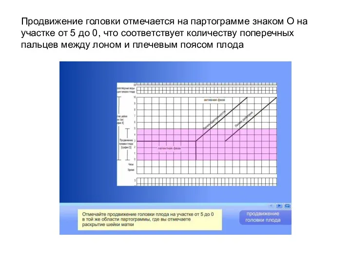 Продвижение головки отмечается на партограмме знаком О на участке от 5 до 0,