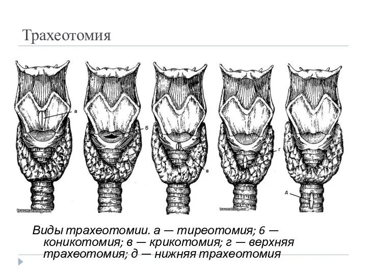 Трахеотомия Виды трахеотомии. а — тиреотомия; 6 — коникотомия; в