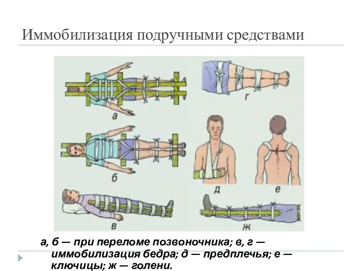 Иммобилизация подручными средствами а, б — при переломе позвоночника; в,