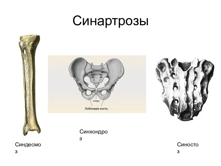 Синартрозы Синдесмоз Синхондроз Синостоз