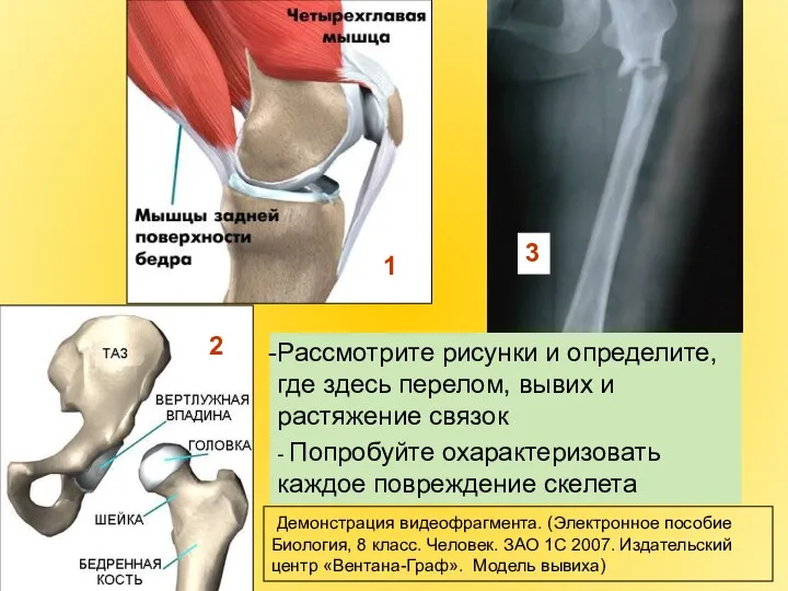 1 2 Рассмотрите рисунки и определите, где здесь перелом, вывих