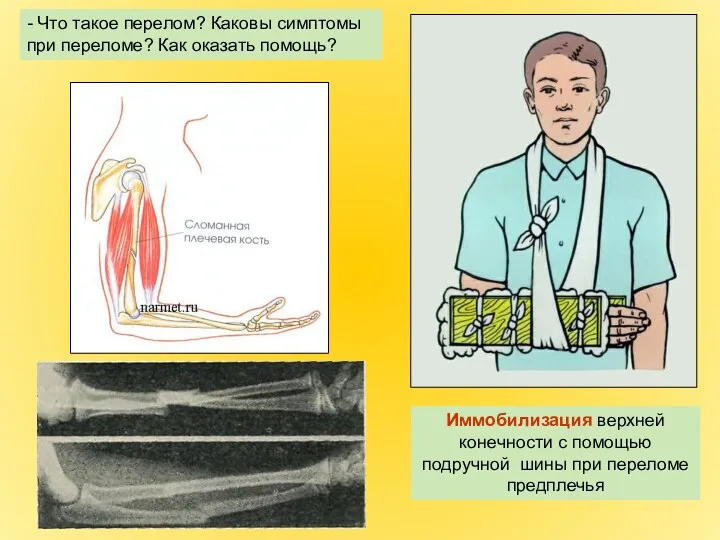 Иммобилизация верхней конечности с помощью подручной шины при переломе предплечья