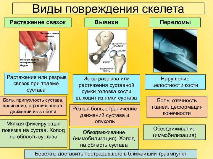 Виды повреждения скелета Растяжение связок Вывихи Переломы Боль, отечность тканей,