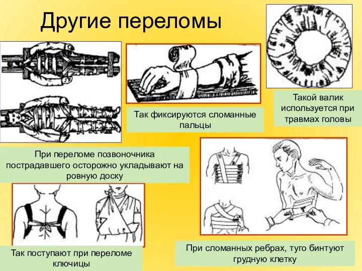 Другие переломы Такой валик используется при травмах головы Так фиксируются