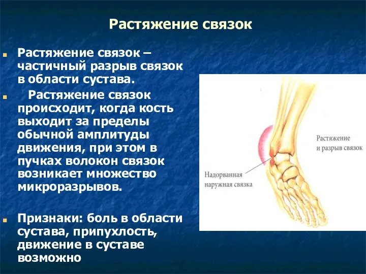 Растяжение связок Растяжение связок – частичный разрыв связок в области сустава. Растяжение связок