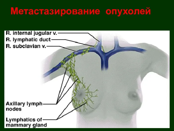 Метастазирование опухолей