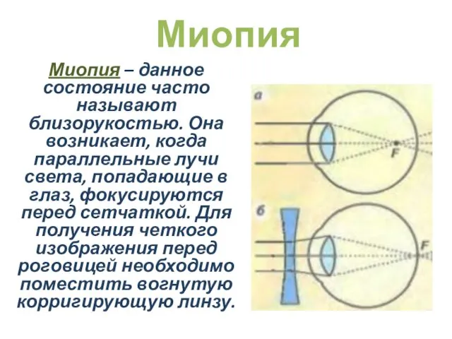 Миопия – данное состояние часто называют близорукостью. Она возникает, когда параллельные лучи света,