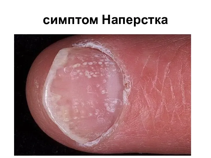 симптом Наперстка