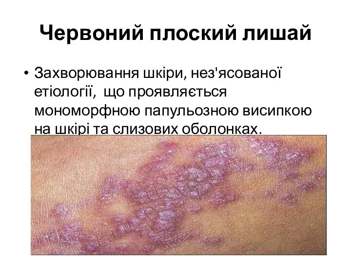 Червоний плоский лишай Захворювання шкіри, нез'ясованої етіології, що проявляється мономорфною папульозною висипкою на