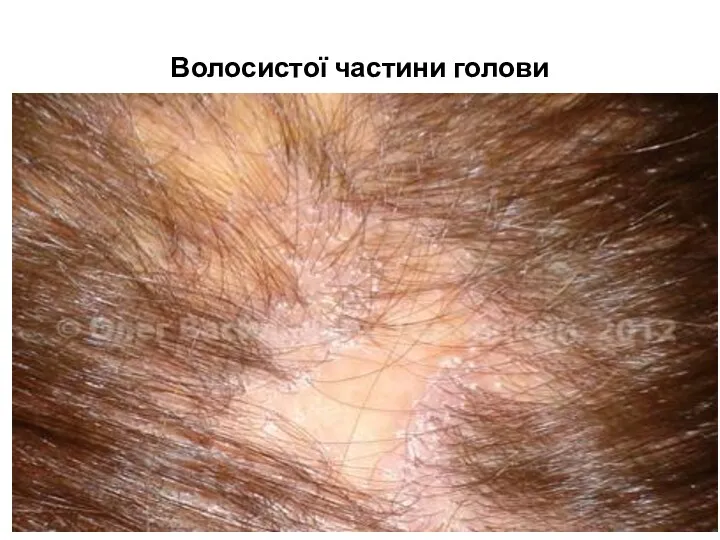 Волосистої частини голови