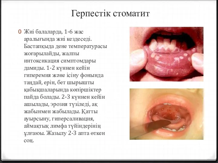 Герпестік стоматит Жиі балаларда, 1-6 жас аралығында жиі кездеседі. Бастапқыда