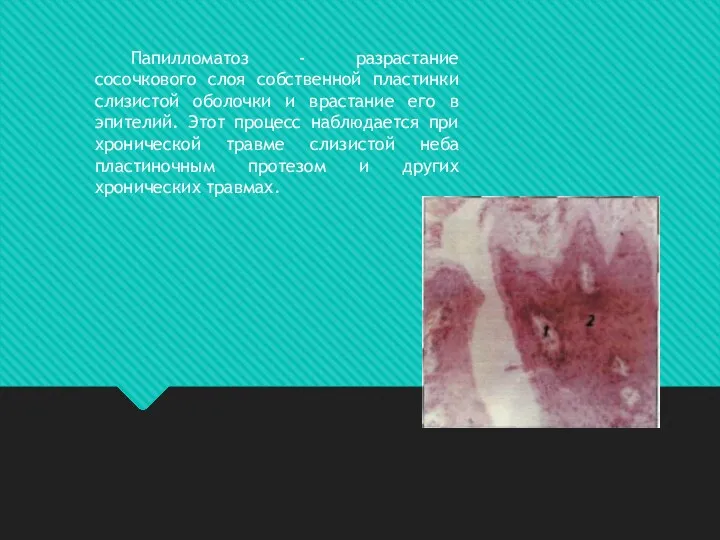 Папилломатоз - разрастание сосочкового слоя собственной пластинки слизистой оболочки и врастание его в