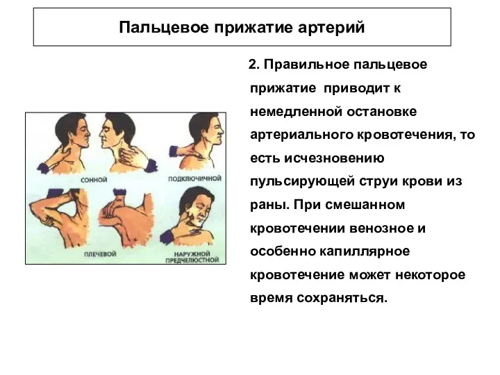 Пальцевое прижатие артерий 2. Правильное пальцевое прижатие приводит к немедленной