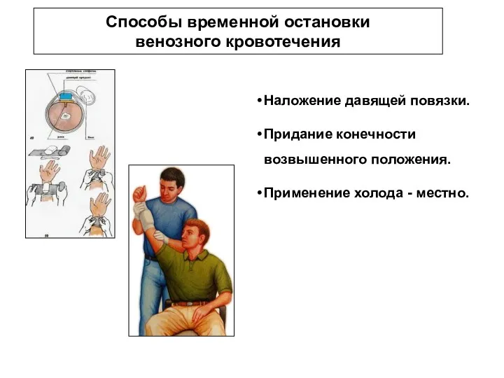 Способы временной остановки венозного кровотечения Наложение давящей повязки. Придание конечности возвышенного положения. Применение холода - местно.