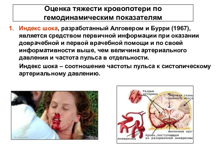 Оценка тяжести кровопотери по гемодинамическим показателям Индекс шока, разработанный Алговером