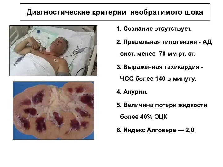 Диагностические критерии необратимого шока 1. Сознание отсутствует. 2. Предельная гипотензия