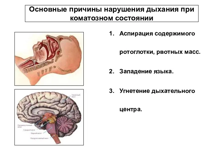 Основные причины нарушения дыхания при коматозном состоянии Аспирация содержимого ротоглотки,