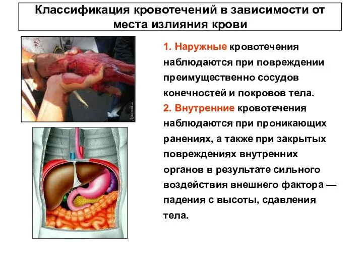 Классификация кровотечений в зависимости от места излияния крови 1. Наружные