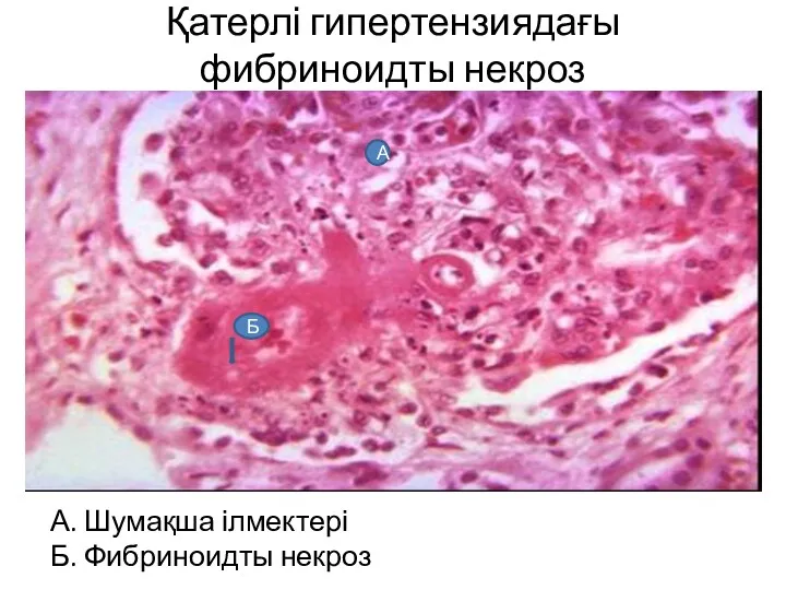 Қатерлі гипертензиядағы фибриноидты некроз А. Шумақша ілмектері Б. Фибриноидты некроз Б А