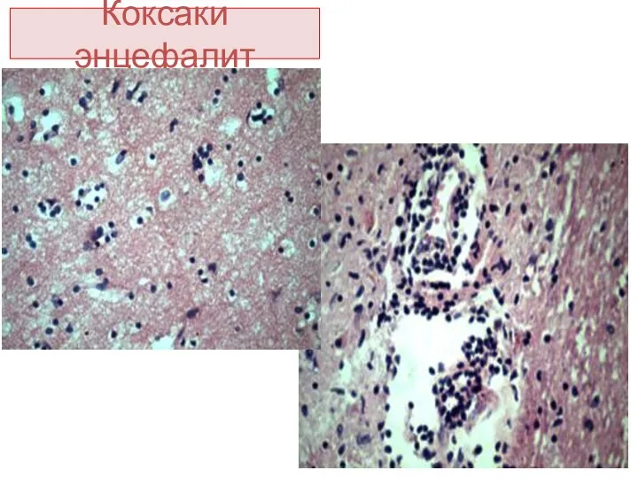 Коксаки энцефалит