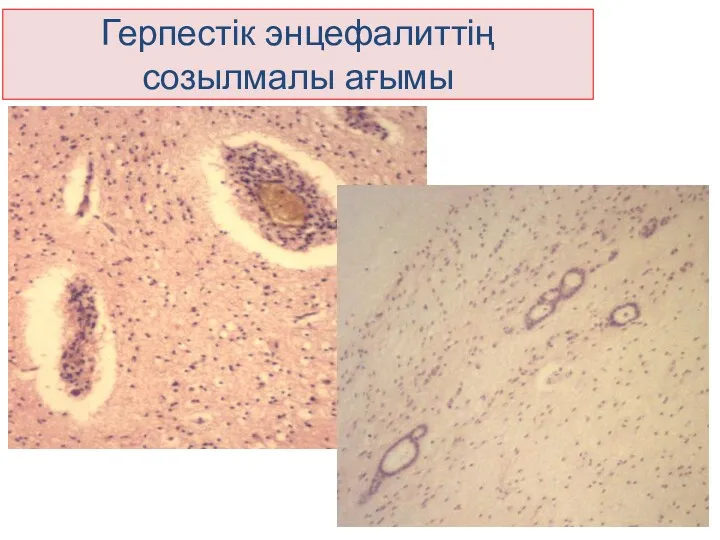 Герпестік энцефалиттің созылмалы ағымы